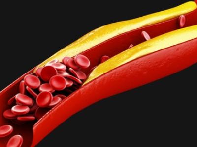 الكولسترول